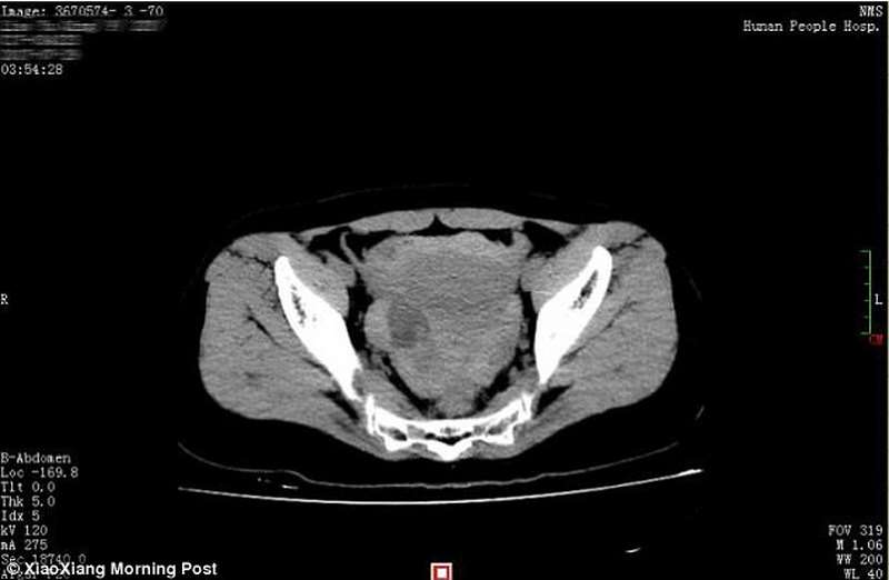 43865f4900000578-4820212-ct_scan_of_xiao_qing_s_pelvis_at_a_hunan_hospital_indicated_a_ru-a-53_1503589426877.jpg